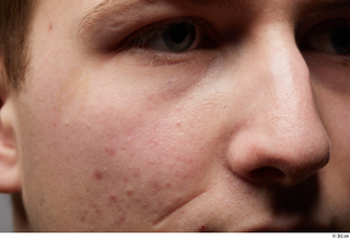 HD Face Skin Casey Schneider cheek face nose scar skin…